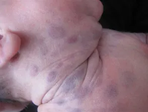 Blueberry muffin syndrome (congenital rubella)