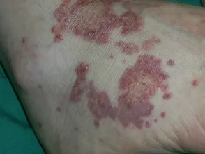 Sjogren vasculitis