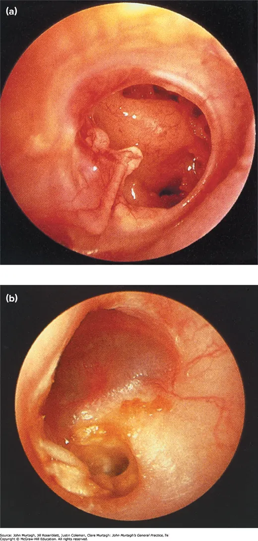 (a) Safe ear — chronic otitis media with loss of the tympanic membrane. (b) Unsafe ear — chronic otitis media with attic cholesteatoma