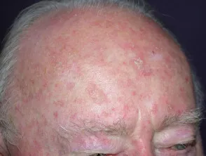 Actinic keratosis