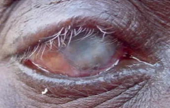 Scarred cornea with lower eyelid trichiasis
