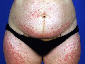 Pruritic Urticated Papules and Plaques of Pregnancy