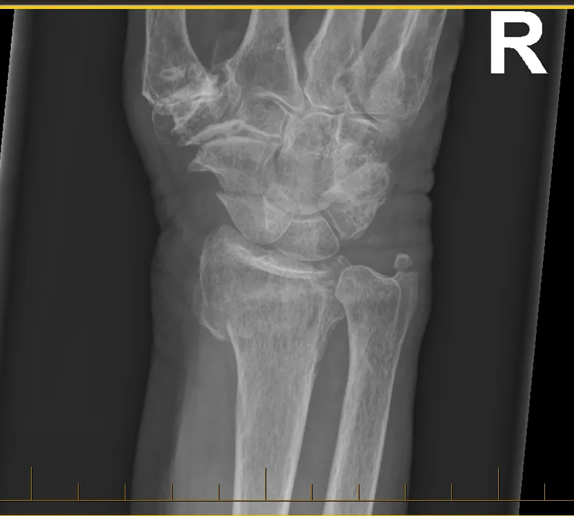 A subtle distal radius fracture, initially missed