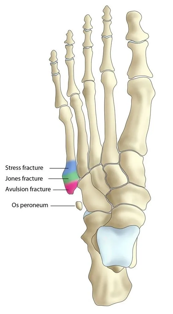 5th metatarsal fracture zones