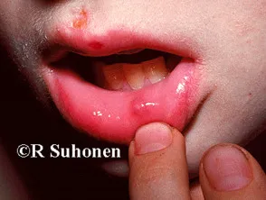 Oral lesion