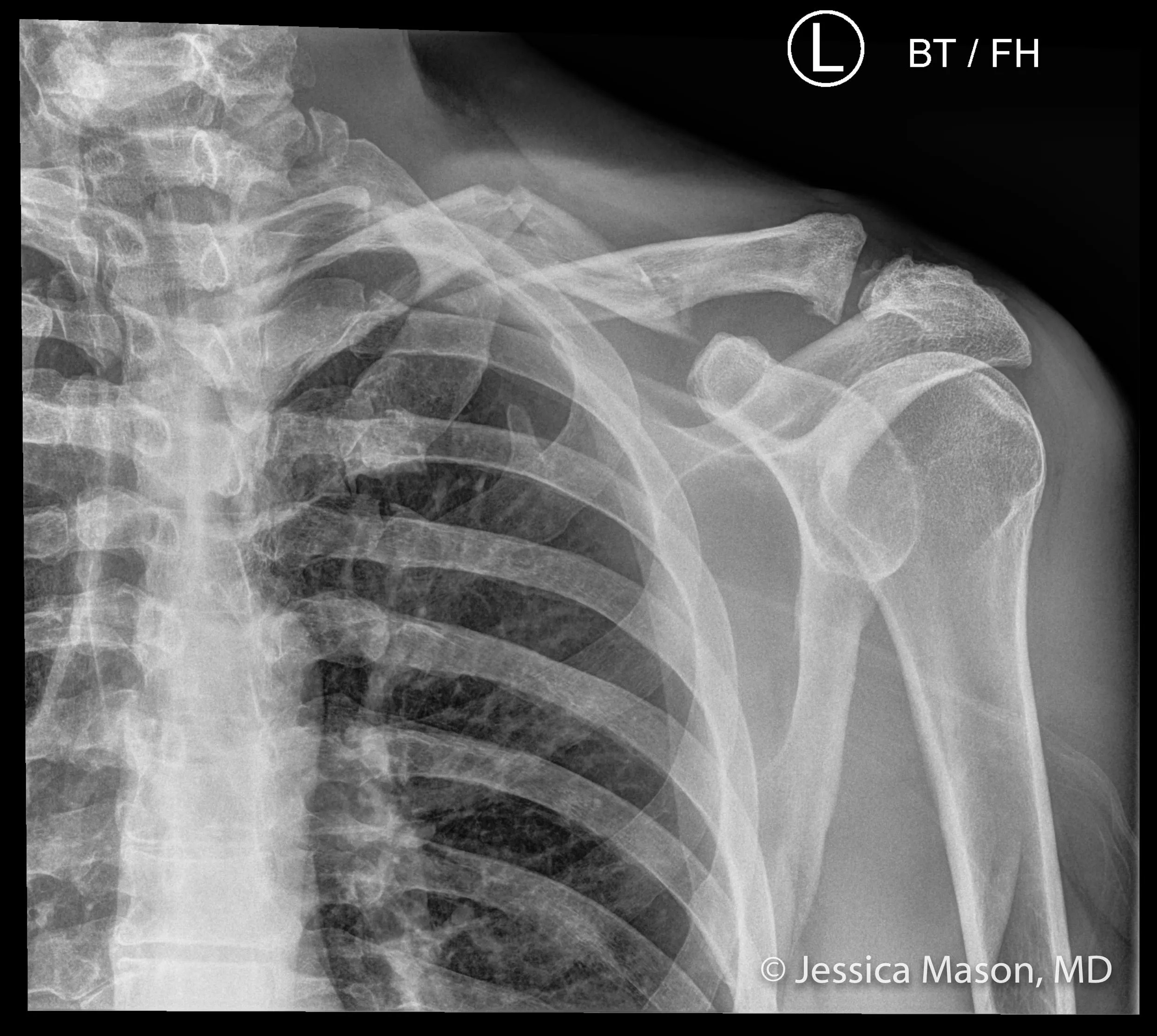 Middle-third clavicle fracture