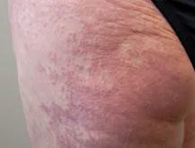 Generalised granuloma annulare