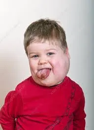 Cystic hygroma