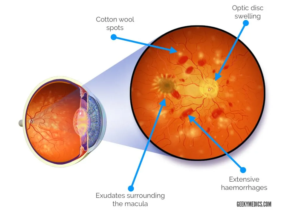Hypertensive retinopathy illustration