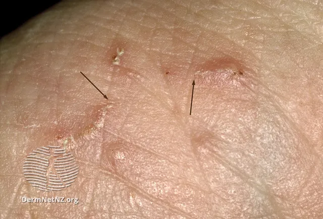Scabies