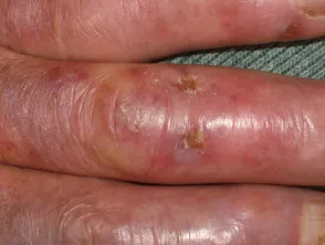 Perniosis