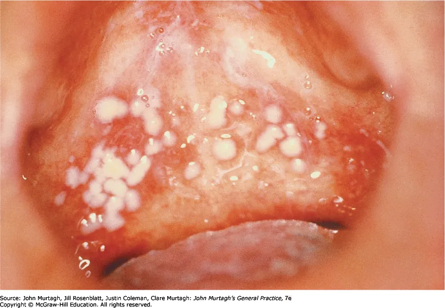 Oral candidiasis