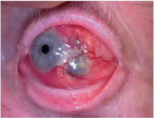 Scleritis — further example
