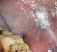 Hyperplastic candidiasis