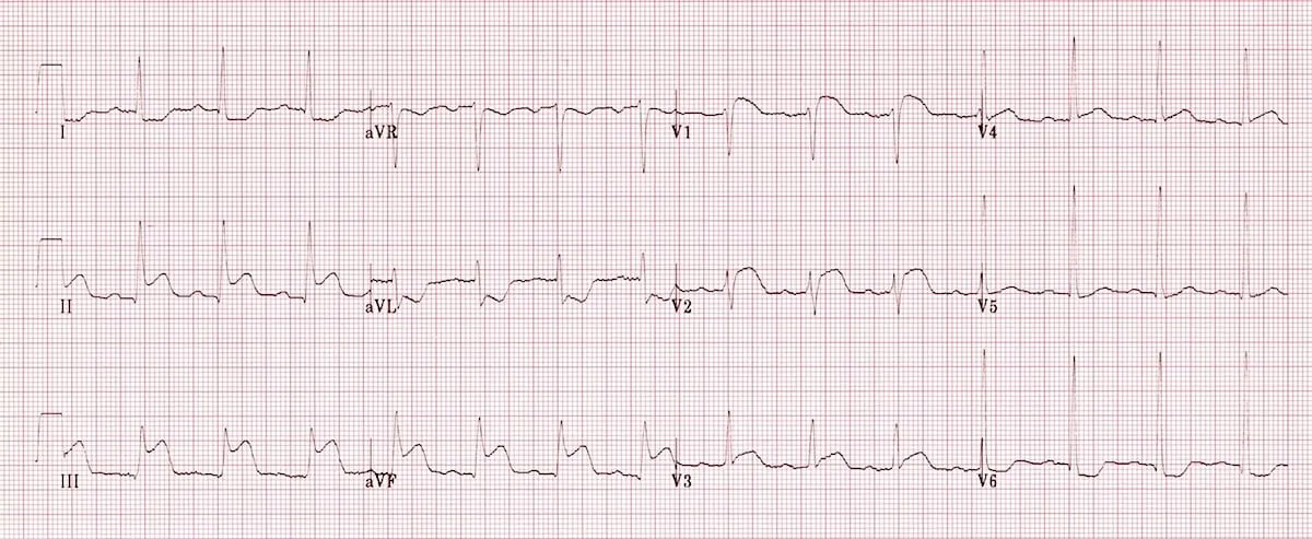 ECG example