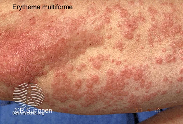 Target lesions