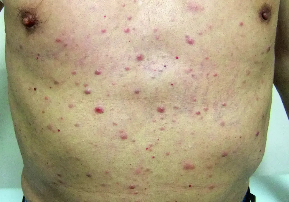 Leukaemia cutis (disseminated)