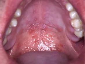 Oral hand, foot and mouth disease