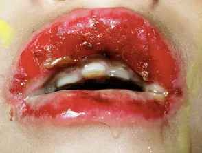 Erythema multiforme of lips
