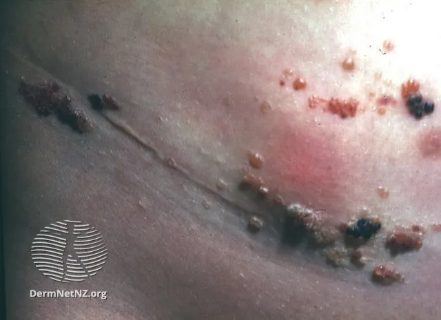 Lymphangioma