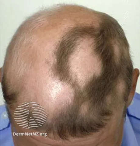 Alopecia areata