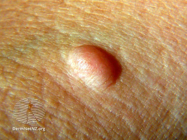 Neurofibromatosis skin findings