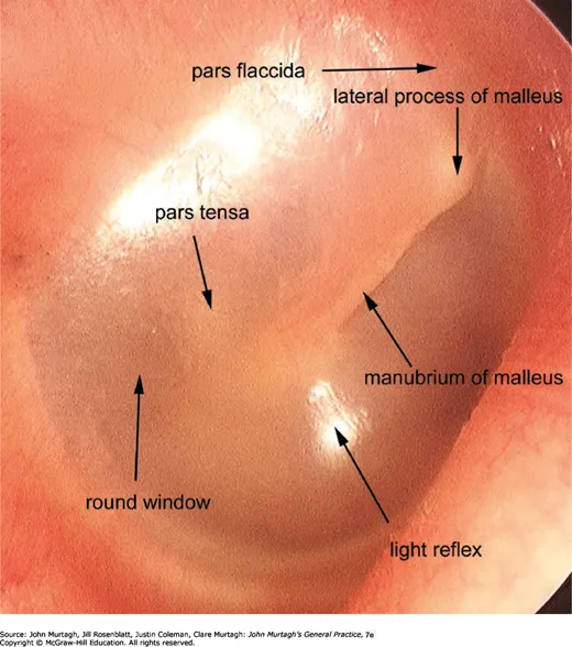 Normal tympanic membrane