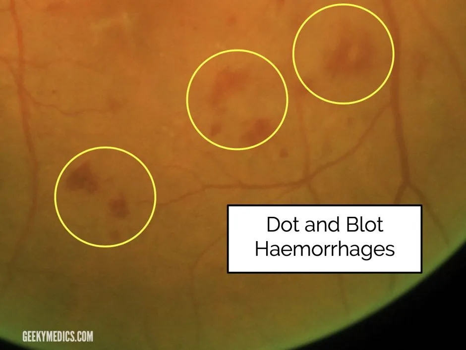 Dot and blot haemorrhages in diabetic retinopathy