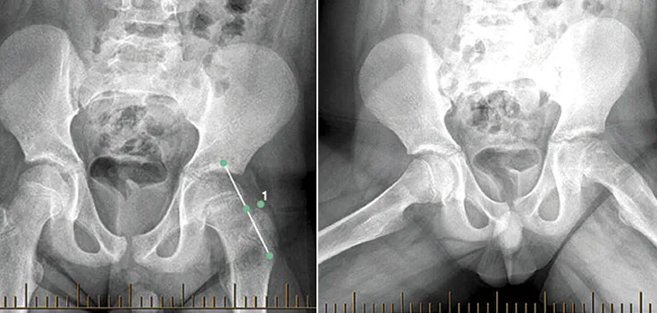 Radiographic appearances of SCFE