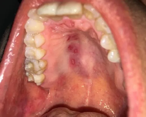 Oral herpes simplex