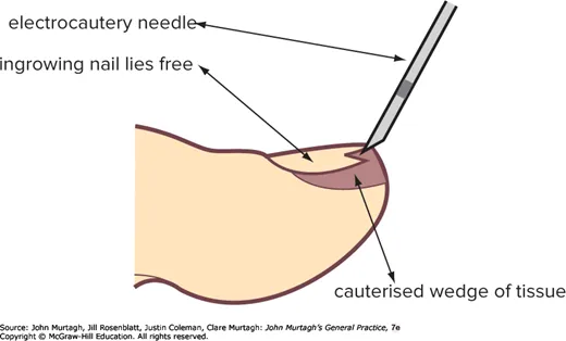 Electrocautery of a wedge of tissue