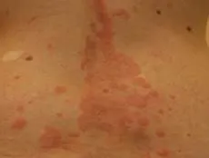 Urticaria mimics