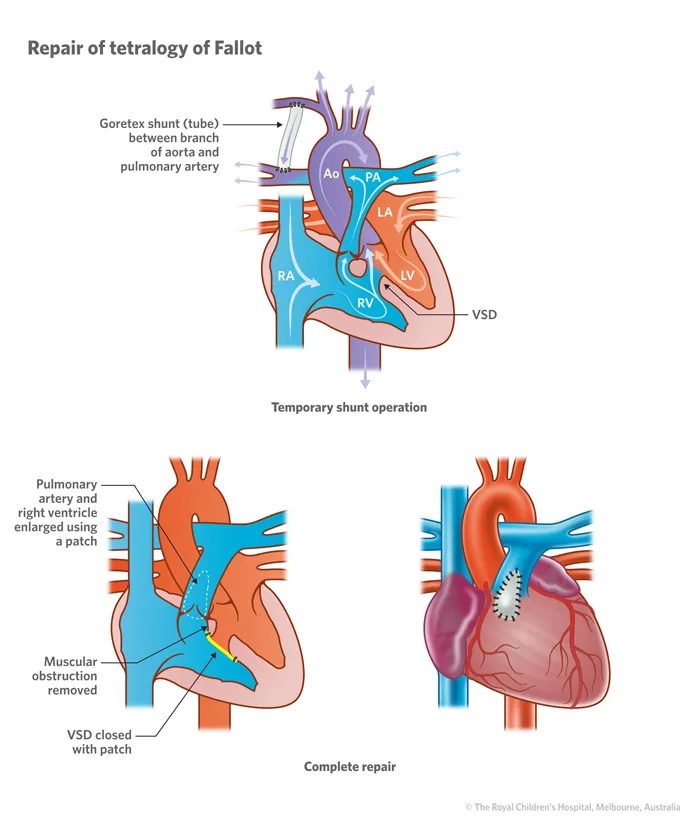 Tetralogy of Fallot repair