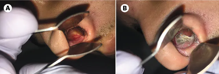 Cautery of Little's area — pre- and post-cautery