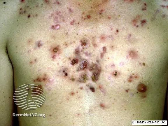 Nodulocystic acne