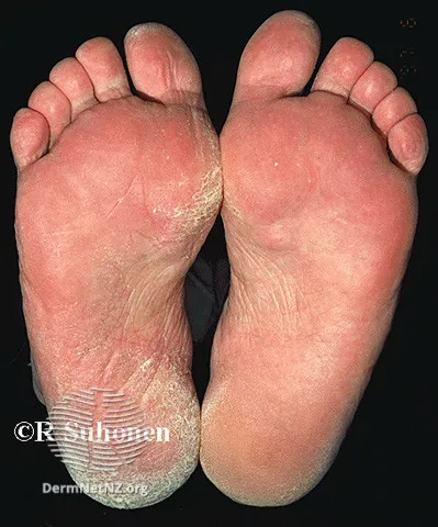 Moccasin tinea pedis
