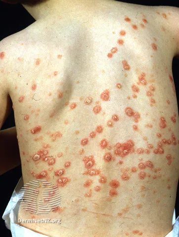 Guttate psoriasis