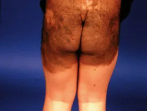 Congenital naevus