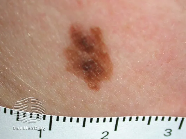 Atypical naevus