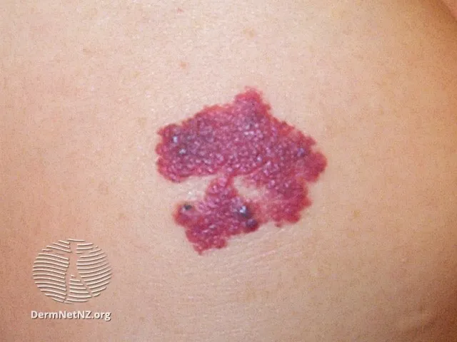 Lymphangioma