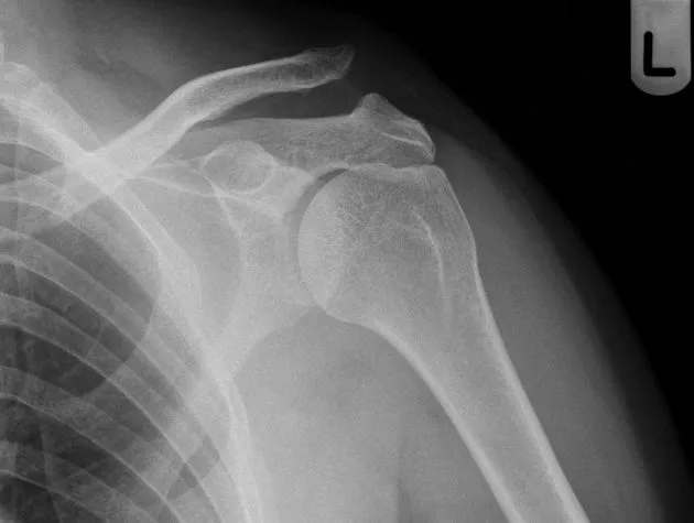 AC joint disruption on X-ray