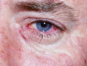 Erythema multiforme of eye