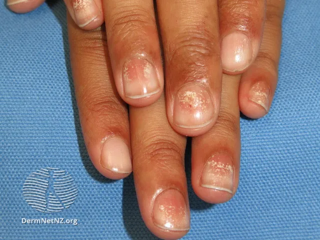 Alopecia areata nail changes