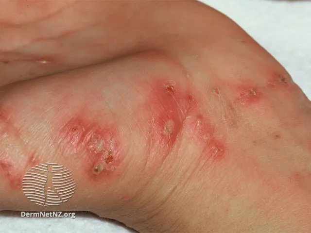 Scabies