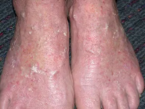 Actinic keratosis