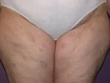 Generalised granuloma annulare