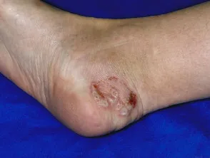 Tinea pedis