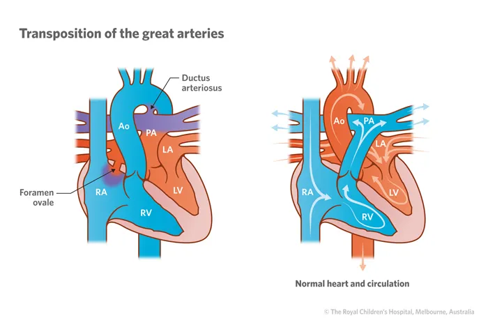 Transposition of the great arteries
