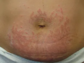 Pruritic Urticated Papules and Plaques of Pregnancy