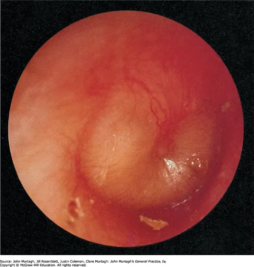 Acute otitis media — bulging tympanic membrane with pus in the middle ear